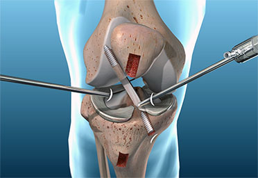 ACL reconstruction