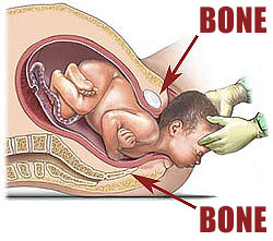 Baby trying to fit through the narrow bone of a birth canal