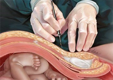 Cesarean section performed by an obstetrician