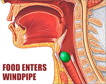 Diagram of food entering windpipe